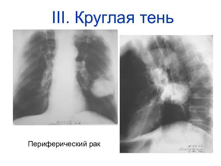 Периферический рак III. Круглая тень