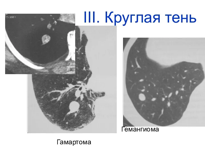 Гамартома Гемангиома III. Круглая тень