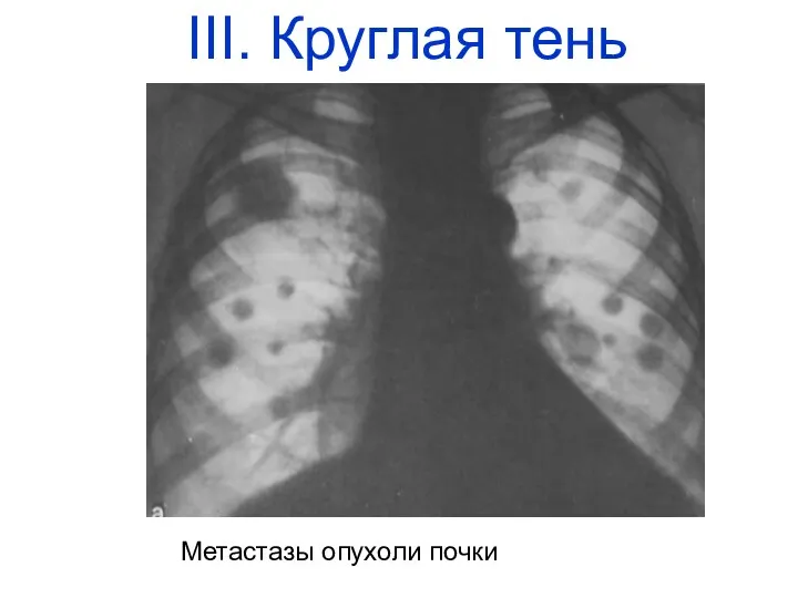 Метастазы опухоли почки III. Круглая тень