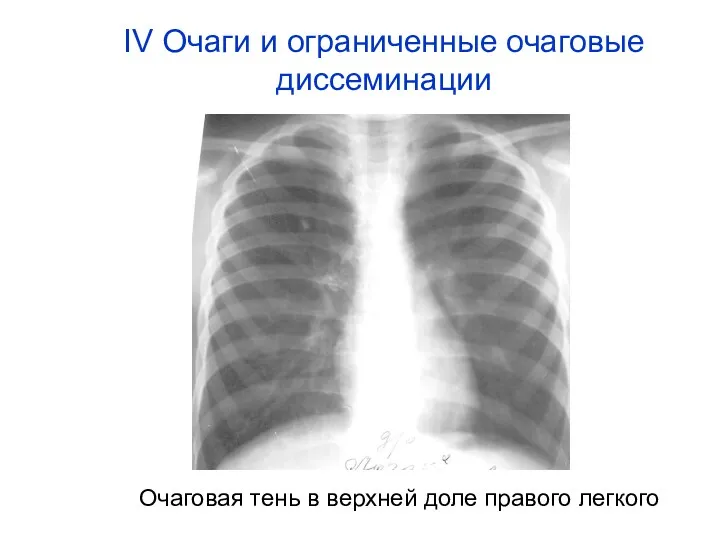 Очаговая тень в верхней доле правого легкого IV Очаги и ограниченные очаговые диссеминации