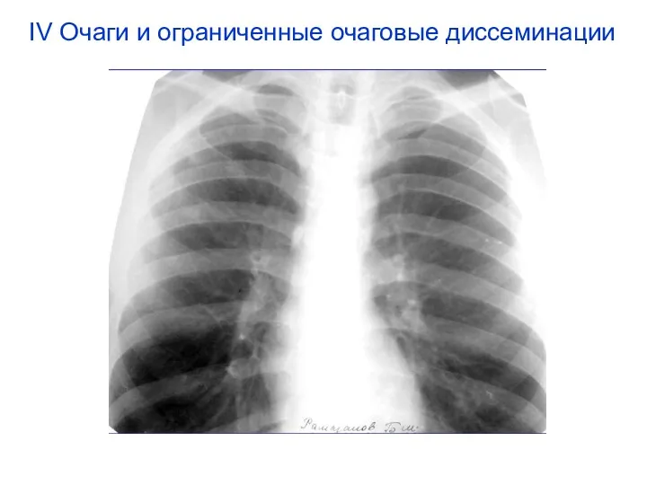 IV Очаги и ограниченные очаговые диссеминации