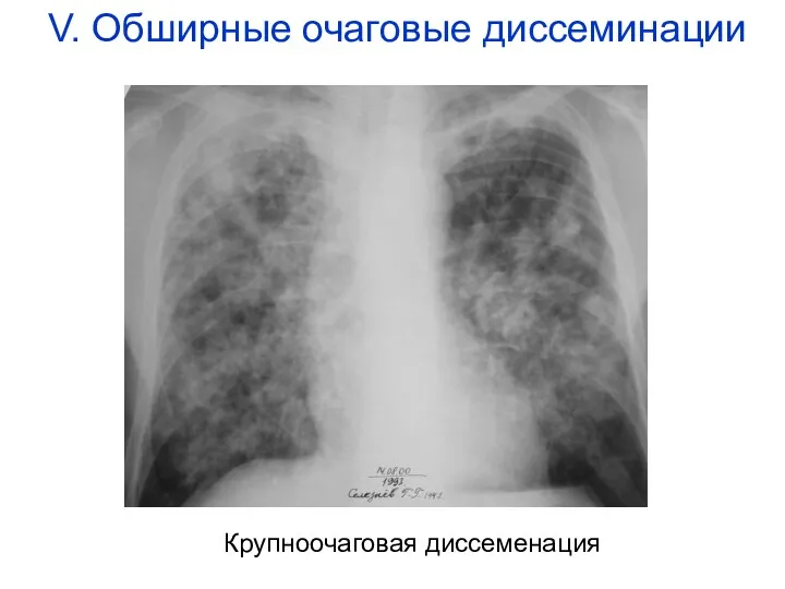 Крупноочаговая диссеменация V. Обширные очаговые диссеминации