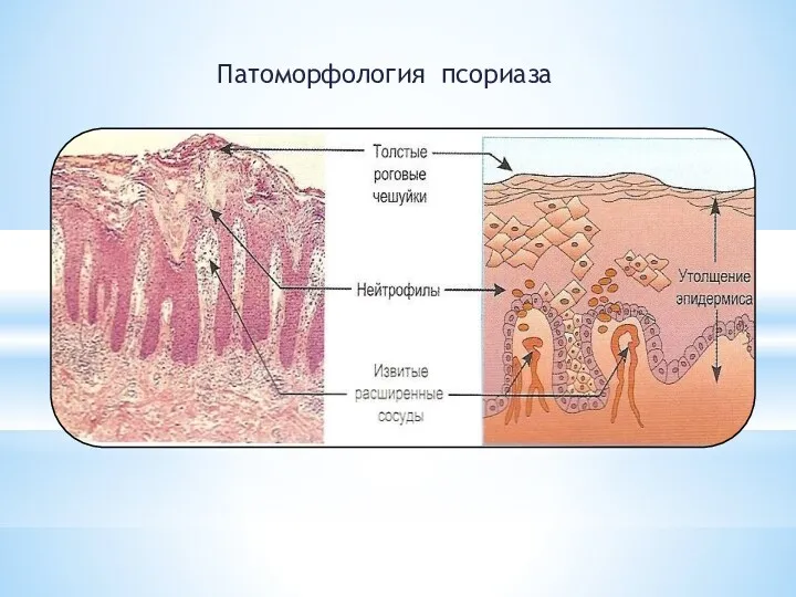 Патоморфология псориаза