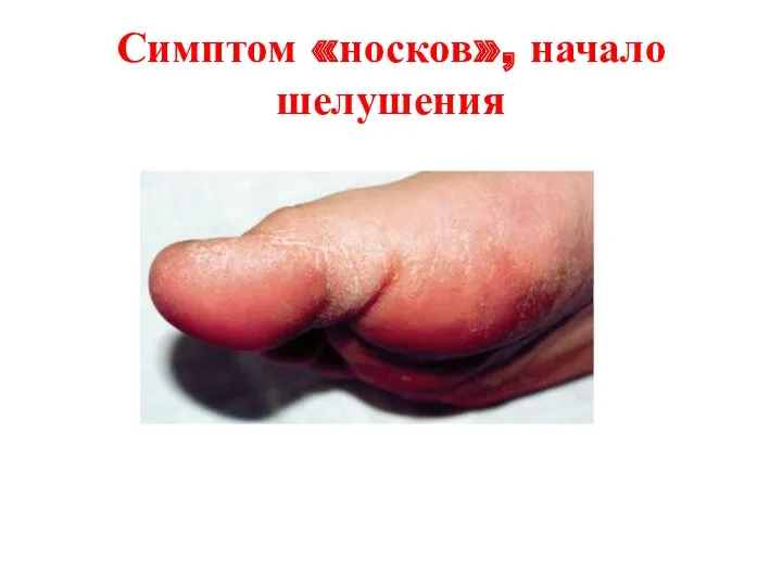 Симптом «носков», начало шелушения