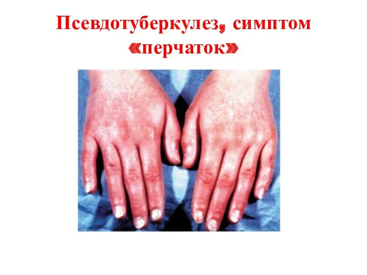Псевдотуберкулез, симптом «перчаток»