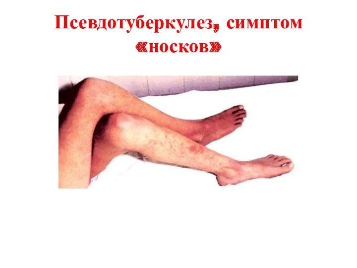 Псевдотуберкулез, симптом «носков»