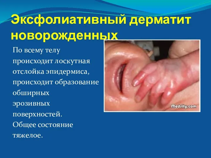 Эксфолиативный дерматит новорожденных По всему телу происходит лоскутная отслойка эпидермиса, происходит образование обширных