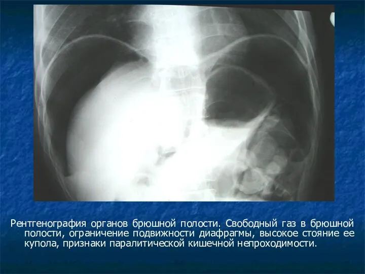 Рентгенография органов брюшной полости. Свободный газ в брюшной полости, ограничение