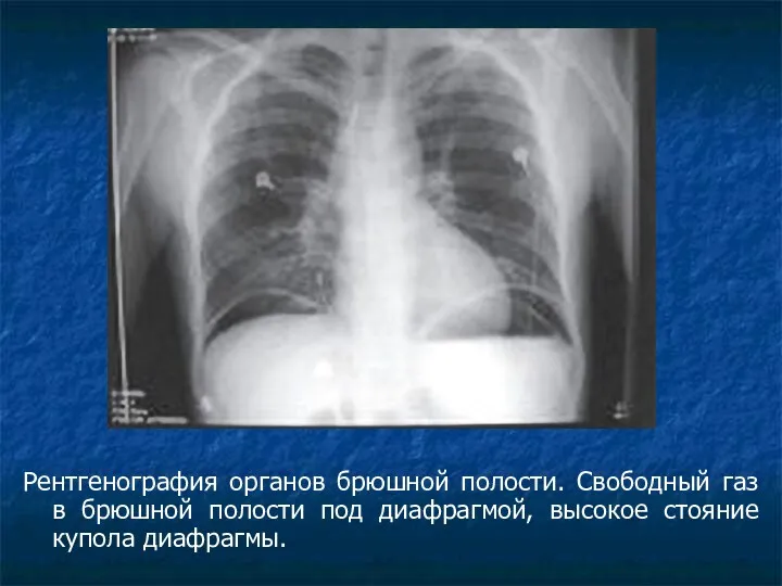 Рентгенография органов брюшной полости. Свободный газ в брюшной полости под диафрагмой, высокое стояние купола диафрагмы.