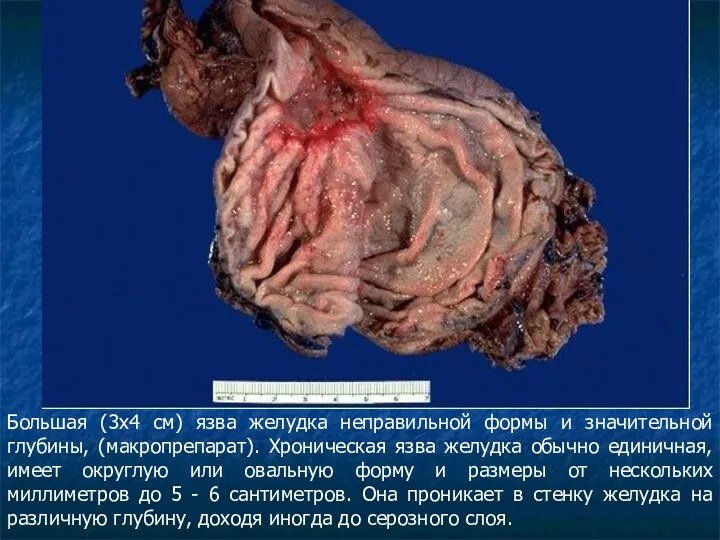 Большая (3x4 см) язва желудка неправильной формы и значительной глубины,