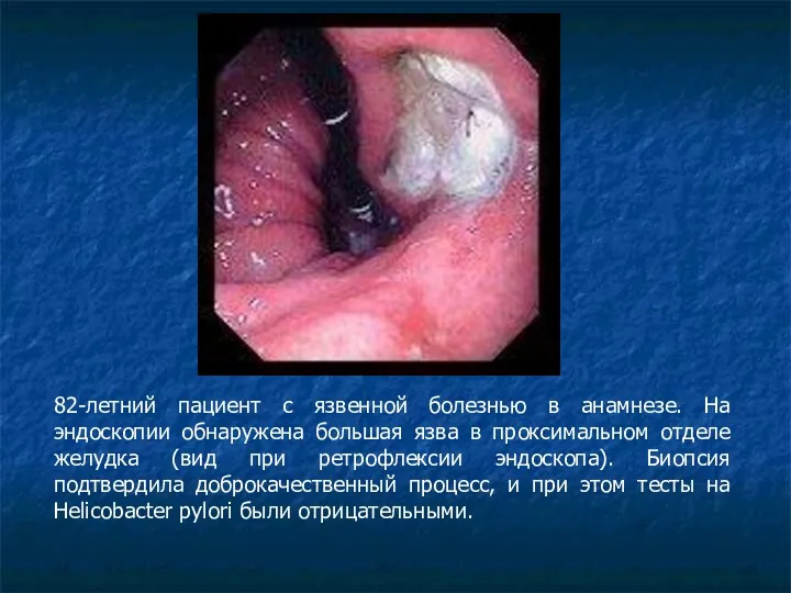 82-летний пациент с язвенной болезнью в анамнезе. На эндоскопии обнаружена