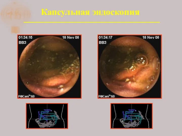 Капсульная эндоскопия