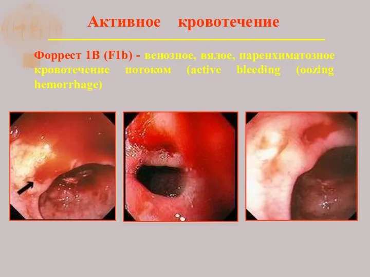 Активное кровотечение Форрест 1В (F1b) - венозное, вялое, паренхиматозное кровотечение потоком (active bleeding (oozing hemorrhage)