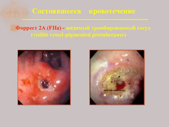 Состоявшееся кровотечение Форрест 2А (FIIa) - видимый тромбированный сосуд (visible vessel-pigmented protuberance)