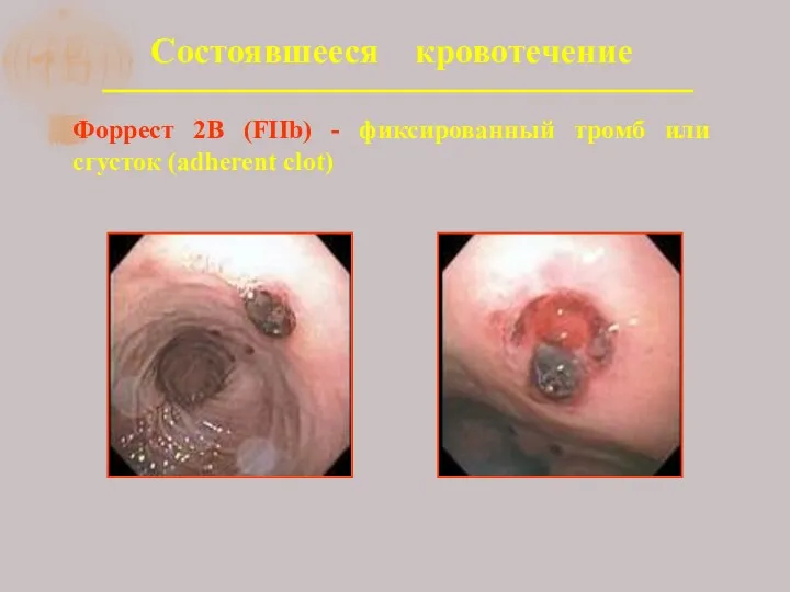 Состоявшееся кровотечение Форрест 2В (FIIb) - фиксированный тромб или сгусток (adherent clot)
