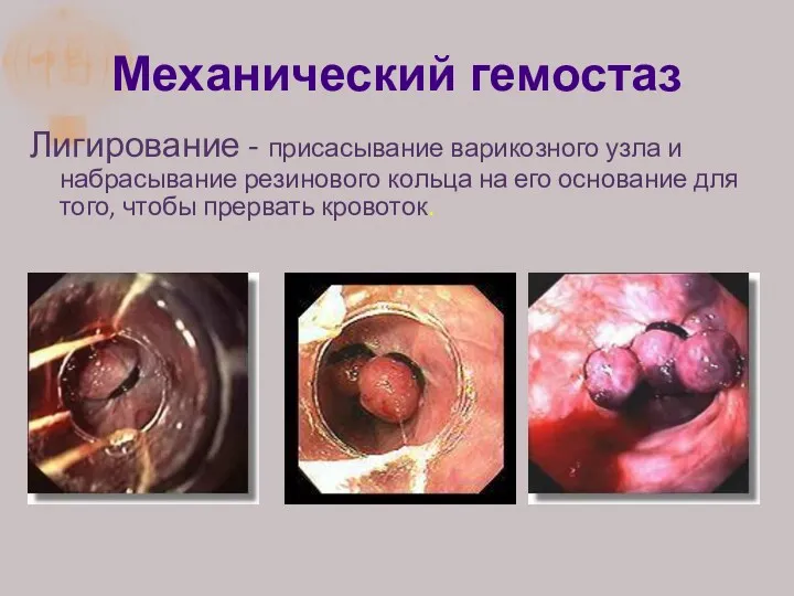 Механический гемостаз Лигирование - присасывание варикозного узла и набрасывание резинового