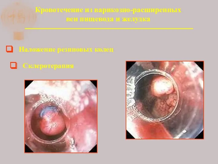 Кровотечение из варикозно-расширенных вен пищевода и желудка Наложение резиновых колец Склеротерапия