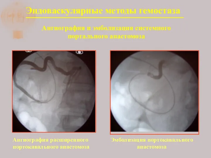 Эндоваскулярные методы гемостаза Ангиография и эмболизация системного портального анастомоза Ангиография расширенного портокавального анастомоза Эмболизация портокавального анастомоза