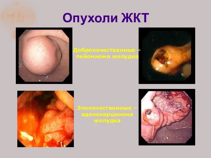 Опухоли ЖКТ Доброкачественные – лейомиома желудка Злокачественные – аденокарцинома желудка