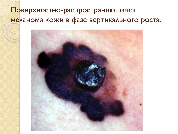 Поверхностно-распространяющаяся меланома кожи в фазе вертикального роста.