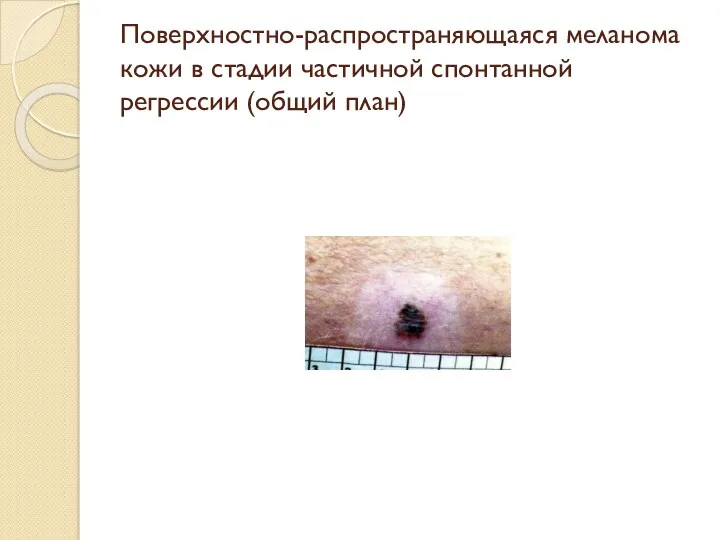 Поверхностно-распространяющаяся меланома кожи в стадии частичной спонтанной регрессии (общий план)