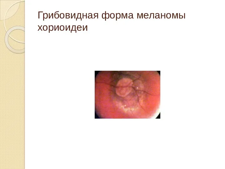 Грибовидная форма меланомы хориоидеи