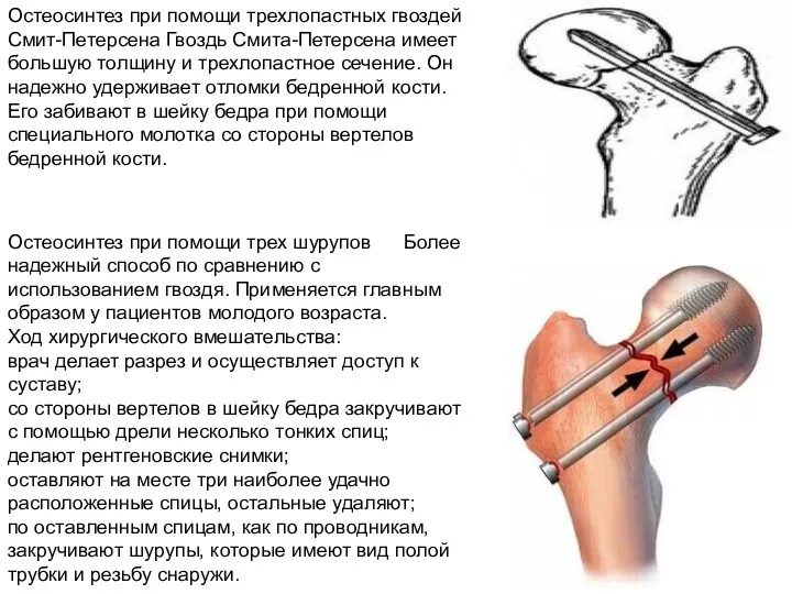 Остеосинтез при помощи трехлопастных гвоздей Смит-Петерсена Гвоздь Смита-Петерсена имеет большую