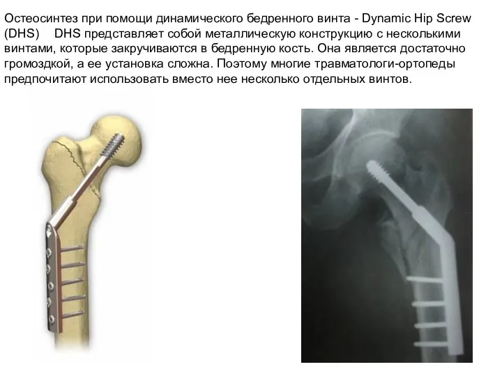 Остеосинтез при помощи динамического бедренного винта - Dynamic Hip Screw