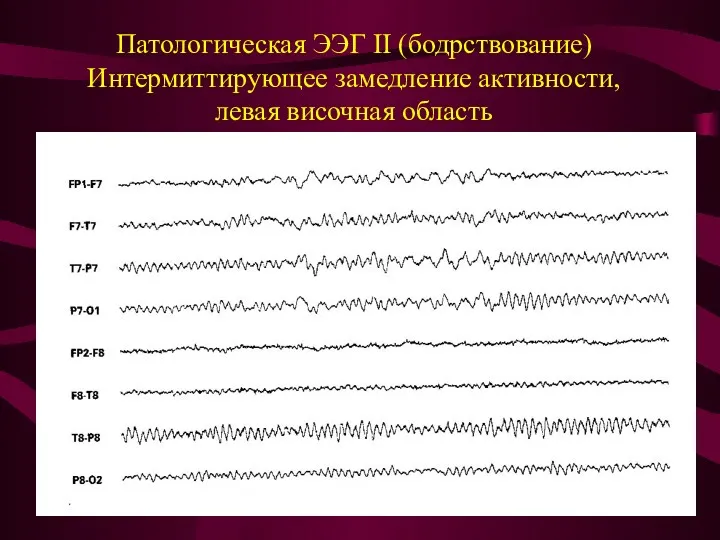 Патологическая ЭЭГ II (бодрствование) Интермиттирующее замедление активности, левая височная область