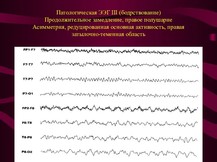 Патологическая ЭЭГ III (бодрствование) Продолжительное замедление, правое полушарие Асимметрия, редуцированная основная активность, правая затылочно-теменная область