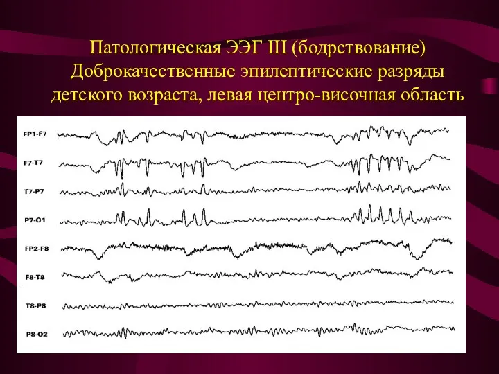 Патологическая ЭЭГ III (бодрствование) Доброкачественные эпилептические разряды детского возраста, левая центро-височная область