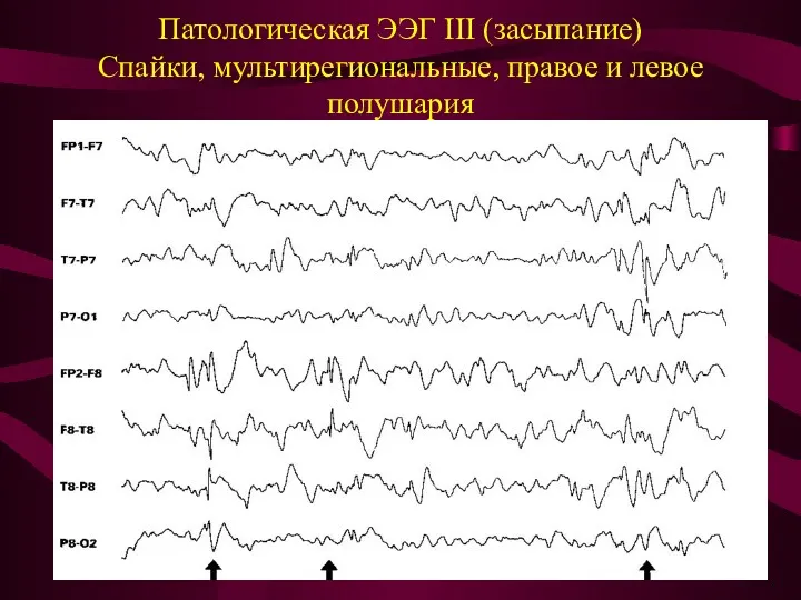 Патологическая ЭЭГ III (засыпание) Спайки, мультирегиональные, правое и левое полушария