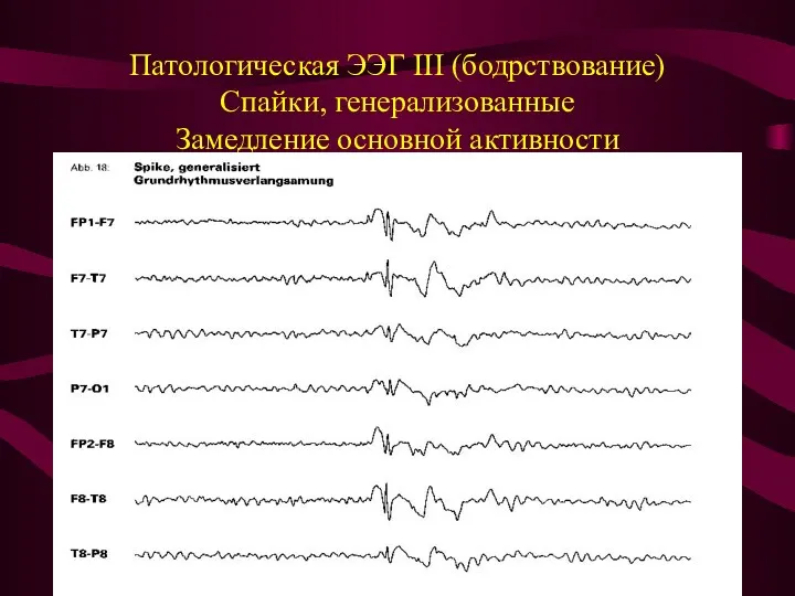 Патологическая ЭЭГ III (бодрствование) Спайки, генерализованные Замедление основной активности