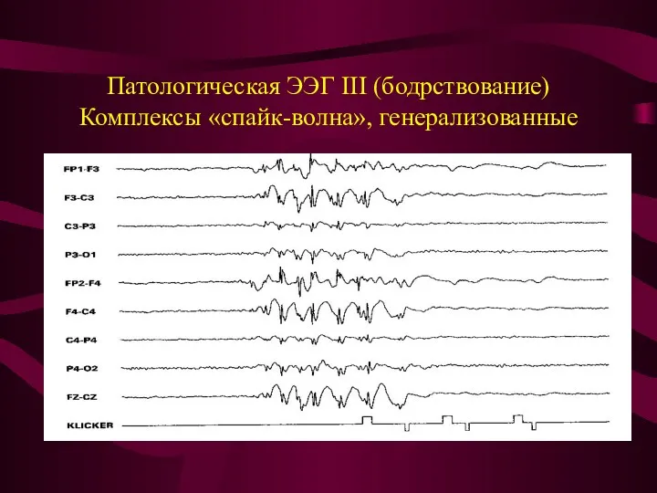 Патологическая ЭЭГ III (бодрствование) Комплексы «спайк-волна», генерализованные