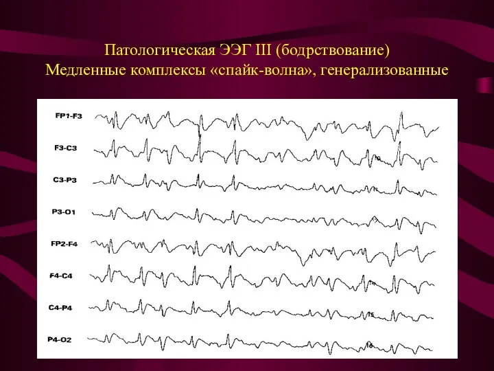 Патологическая ЭЭГ III (бодрствование) Медленные комплексы «спайк-волна», генерализованные