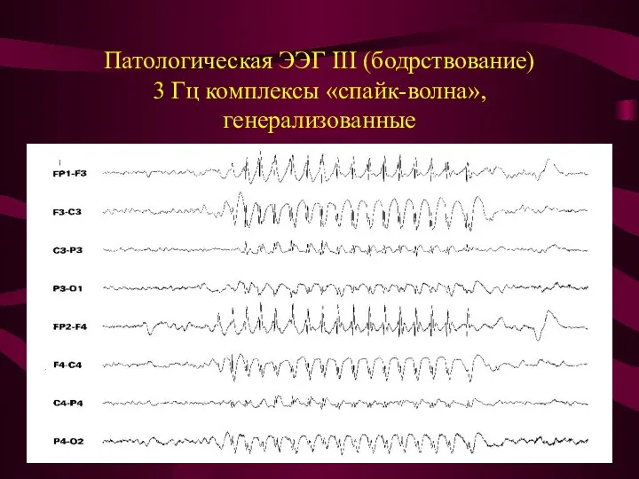 Патологическая ЭЭГ III (бодрствование) 3 Гц комплексы «спайк-волна», генерализованные