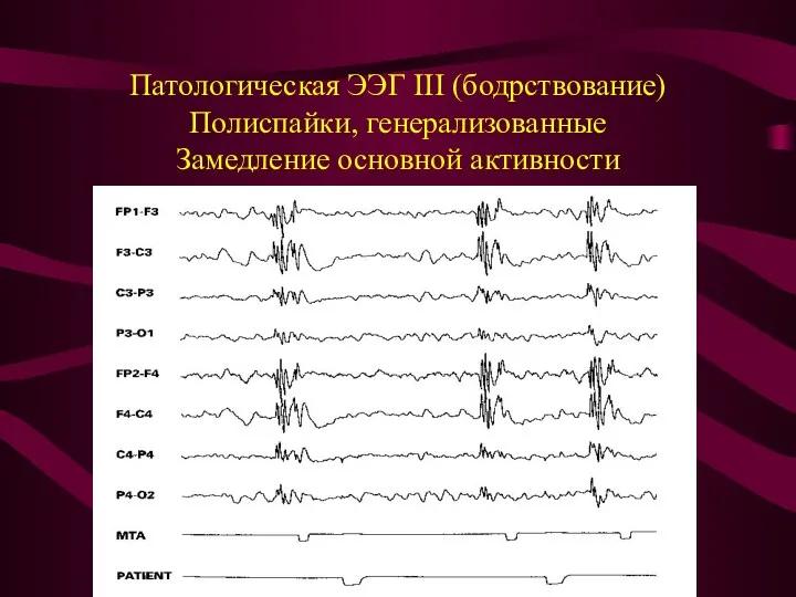 Патологическая ЭЭГ III (бодрствование) Полиспайки, генерализованные Замедление основной активности