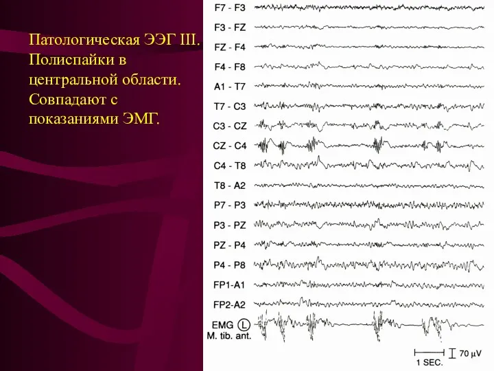 Патологическая ЭЭГ III. Полиспайки в центральной области. Совпадают с показаниями ЭМГ.