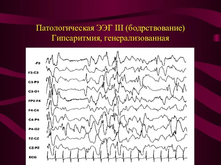 Патологическая ЭЭГ III (бодрствование) Гипсаритмия, генерализованная