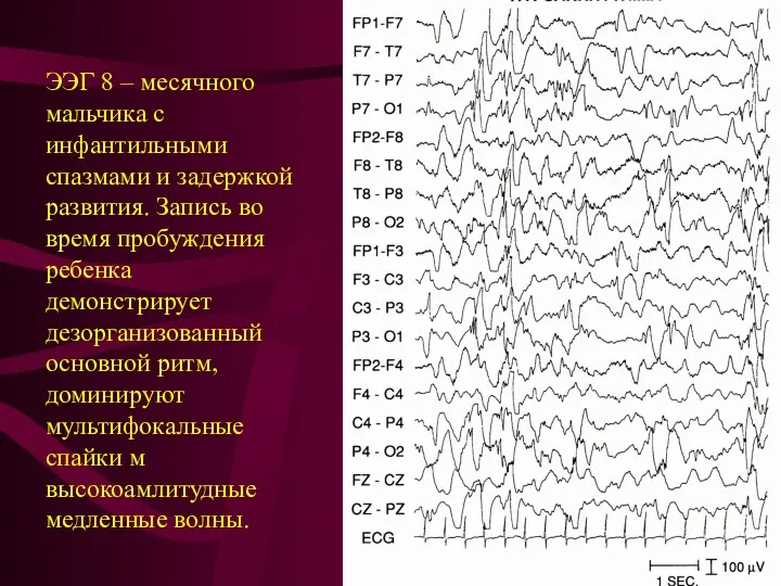 ЭЭГ 8 – месячного мальчика с инфантильными спазмами и задержкой