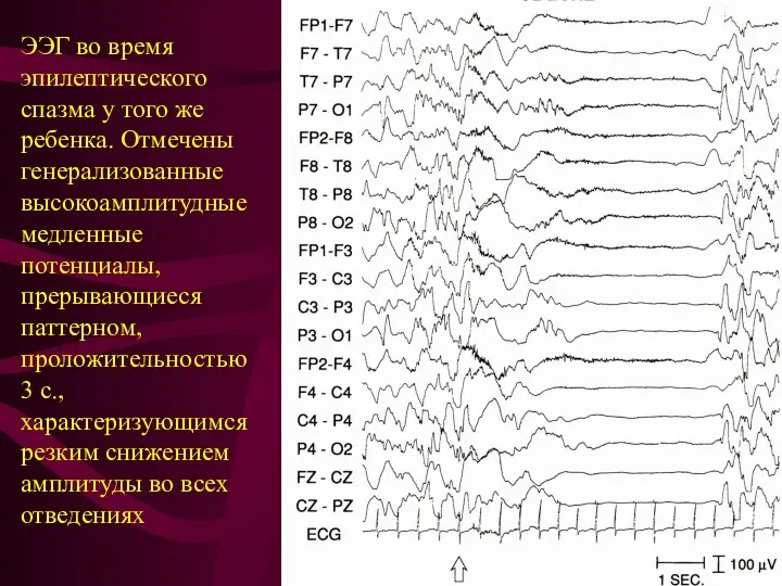 ЭЭГ во время эпилептического спазма у того же ребенка. Отмечены
