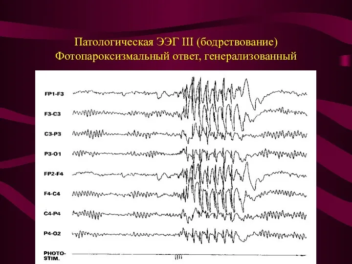 Патологическая ЭЭГ III (бодрствование) Фотопароксизмальный ответ, генерализованный