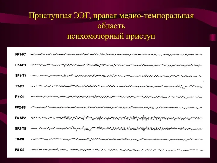 Приступная ЭЭГ, правая медио-темпоральная область психомоторный приступ