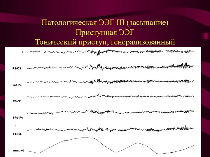 Патологическая ЭЭГ III (засыпание) Приступная ЭЭГ Тонический приступ, генерализованный