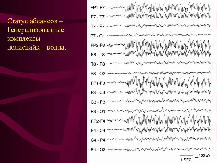 Статус абсансов – Генерализованные комплексы полиспайк – волна.