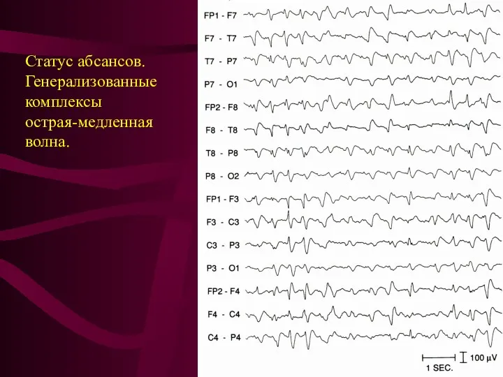 Статус абсансов. Генерализованные комплексы острая-медленная волна.