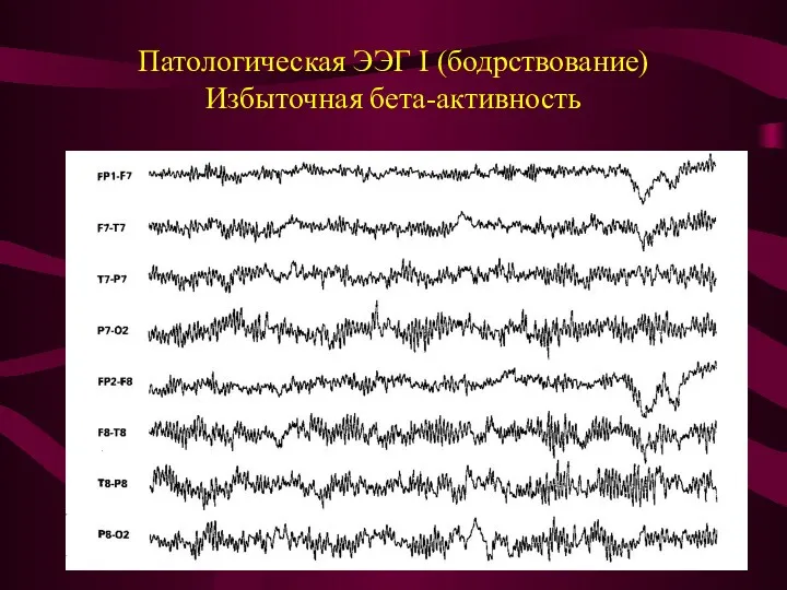 Патологическая ЭЭГ I (бодрствование) Избыточная бета-активность