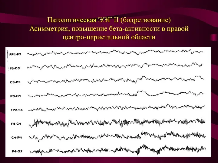 Патологическая ЭЭГ II (бодрствование) Асимметрия, повышение бета-активности в правой центро-париетальной области