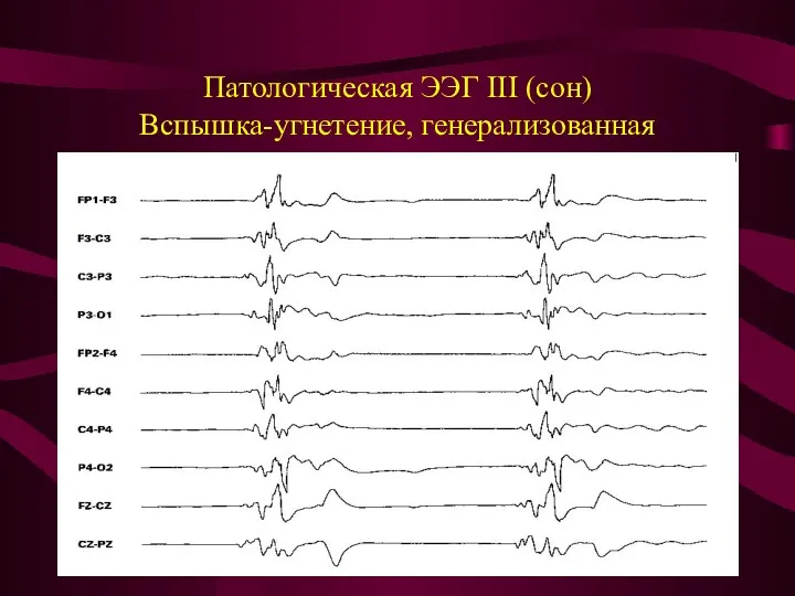 Патологическая ЭЭГ III (сон) Вспышка-угнетение, генерализованная