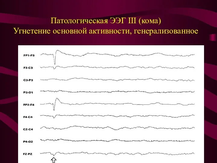 Патологическая ЭЭГ III (кома) Угнетение основной активности, генерализованное